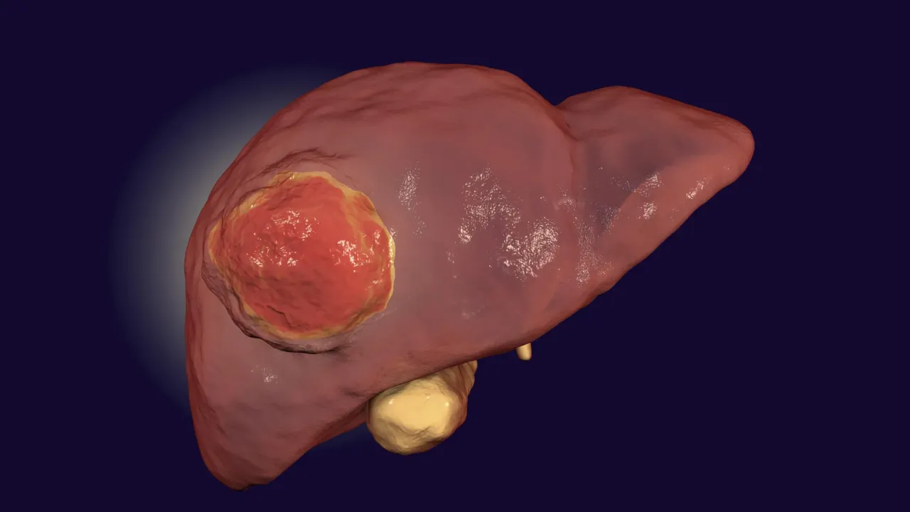 FDA Onaylı İlaç, Nadir Karaciğer Kanserine İmmünTedaviyi Tekrar Çalıştırıyor